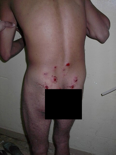 welts on mans buttocks from being  shot by prison guards at Abu Gharib prison in Iraq